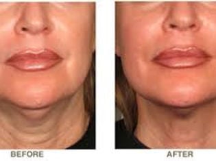 Ultherapy-2 Ultherapy-2