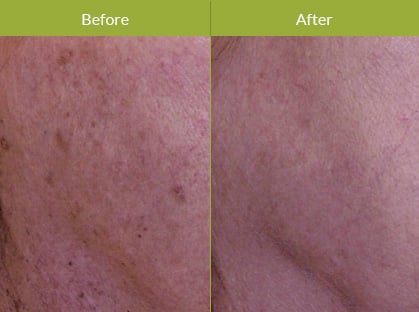 IPL Photo-Rejuvenation IPL Photo-Rejuvenation