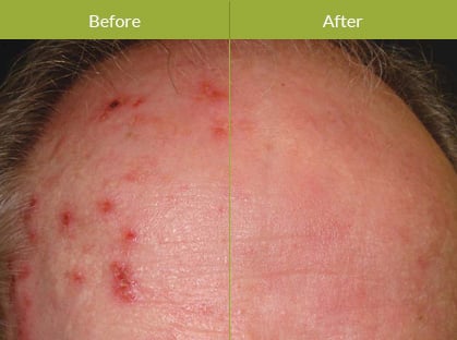 PDT – Photodynamic Therapy PDT – Photodynamic Therapy