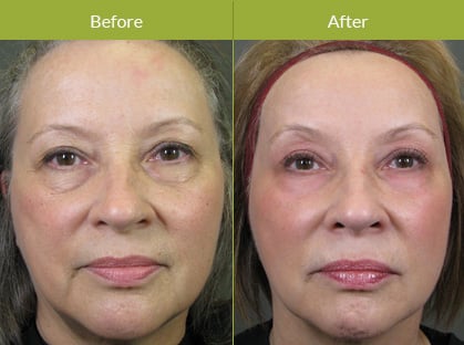What is CO2 laser skin resurfacing? What is CO2 laser skin resurfacing?