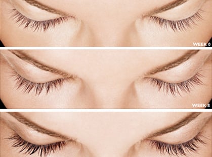 What is Latisse® Eyelash Treatment? What is Latisse® Eyelash Treatment?