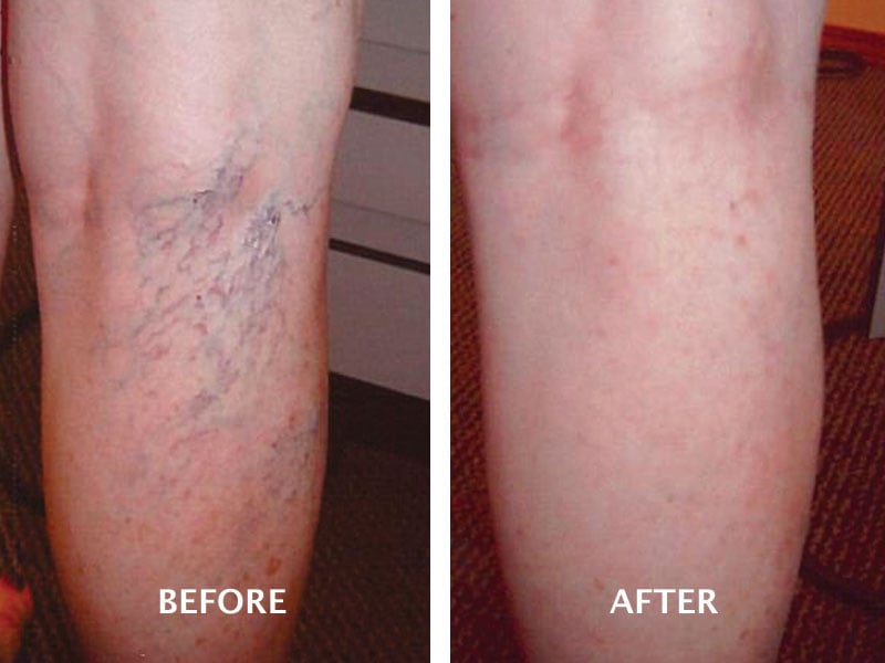 Fotona Skintightning Fotona Skintightning