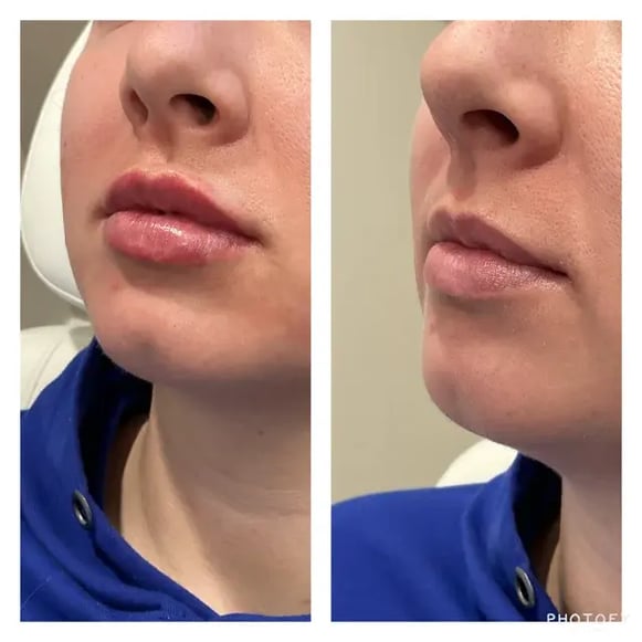 before-and-after-close-up-of-a-woman-showing-smoother-and-more-defined-lips-after-dermal-fillers-saskatoon-treatment