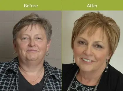 before-and-after-comparison-of-a-woman-smiling-showing-visible-results-from-dermal-fillers-saskatoon-treatment-with-smoother-skin-and-rejuvenated-appearance