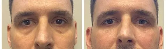 before-and-after-image-of-a-man-showing-reduced-under-eye-hollows-and-smoother-skin-after-dermal-fillers-saskatoon-treatment