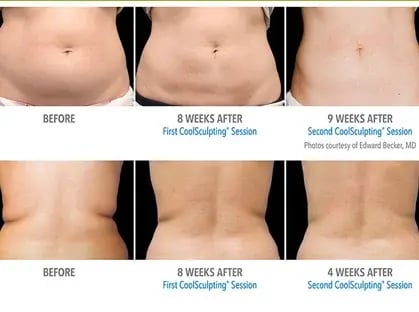 before-and-after-stomach-and-back-photos-showing-fat-reduction-after-coolsculpting-treatments-demonstrating-results-of-body-contouring-saskatoon-services