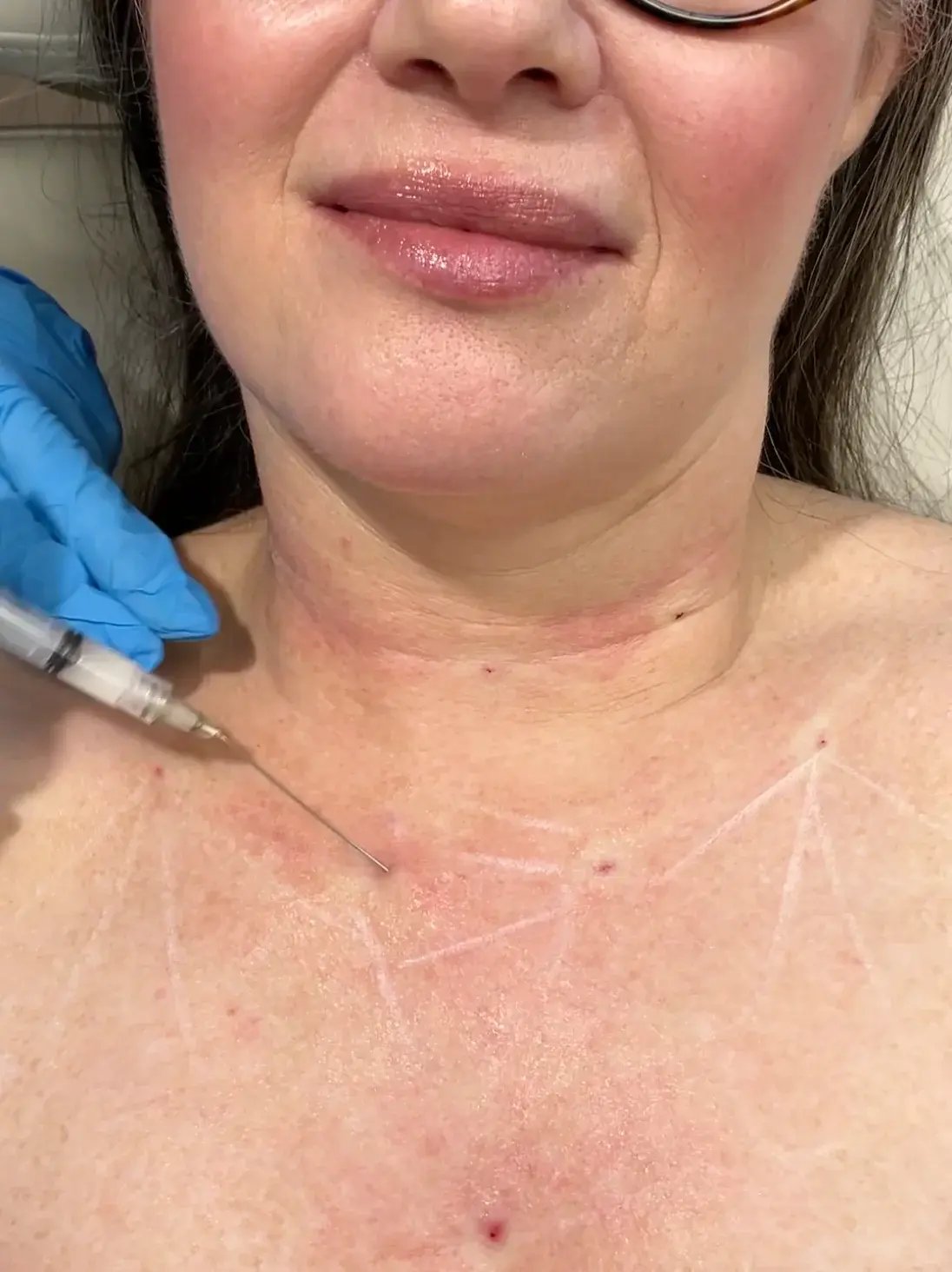 close-up-of-woman’s-chest-with-blue-gloved-hand-holding-syringe-above-marked-skin