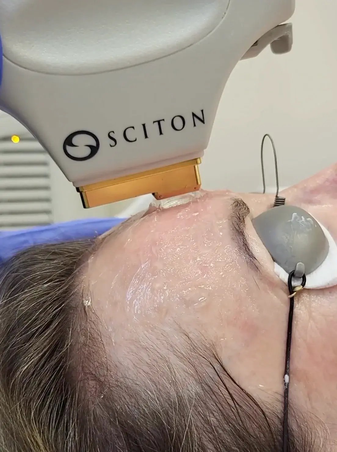 close-up-side-view-of-woman-receiving-ipl-treatment-on-forehead-with-protective-goggles-and-device-applicator-touching-skin-during-procedure