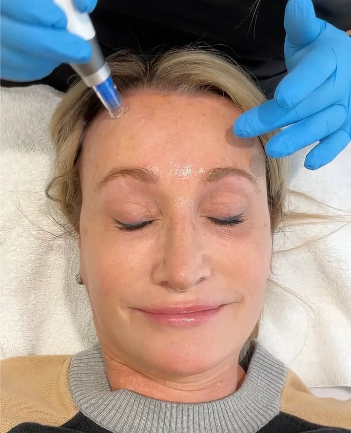 Does Microneedling Help With Skin Tightening?