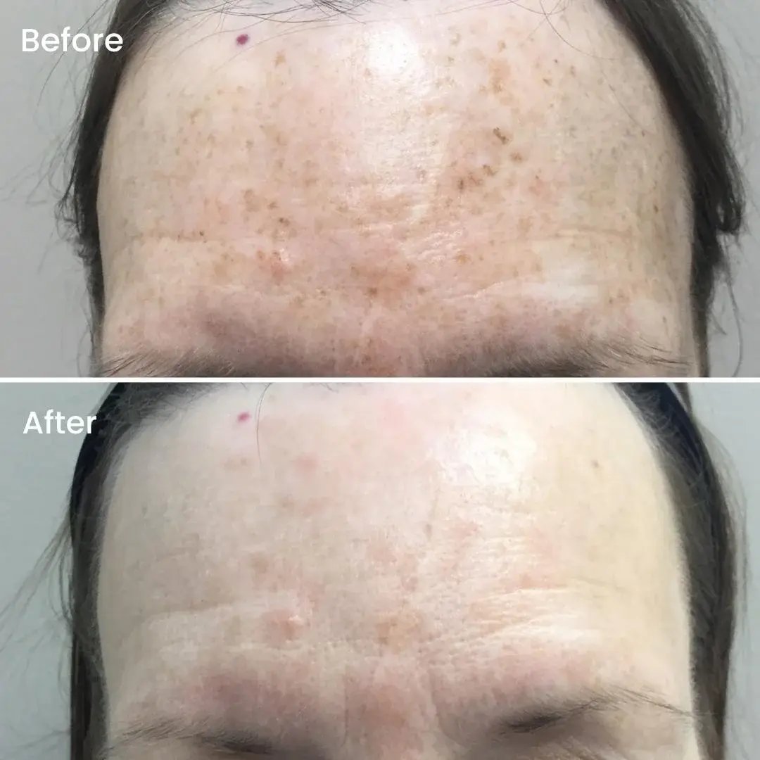 forehead-showing-brown-sunspots-in-before-photo-and-clearer-smoother-skin-in-after-photo-demonstrating-intense-pulsed-light-results-on-pigmentation