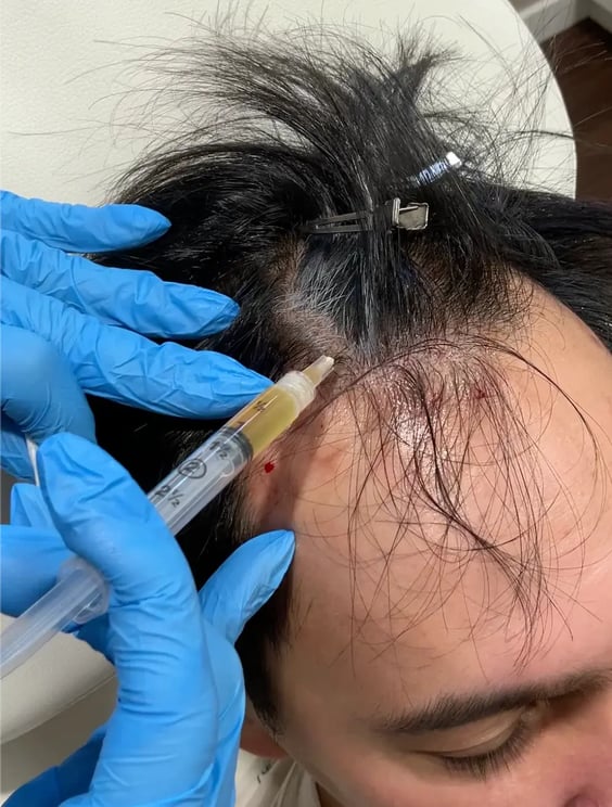 gloved-hands-injecting-yellow-prp-into-a-man’s-scalp-with-hair-clipped-back-as-part-of-prp-saskatoon-treatment