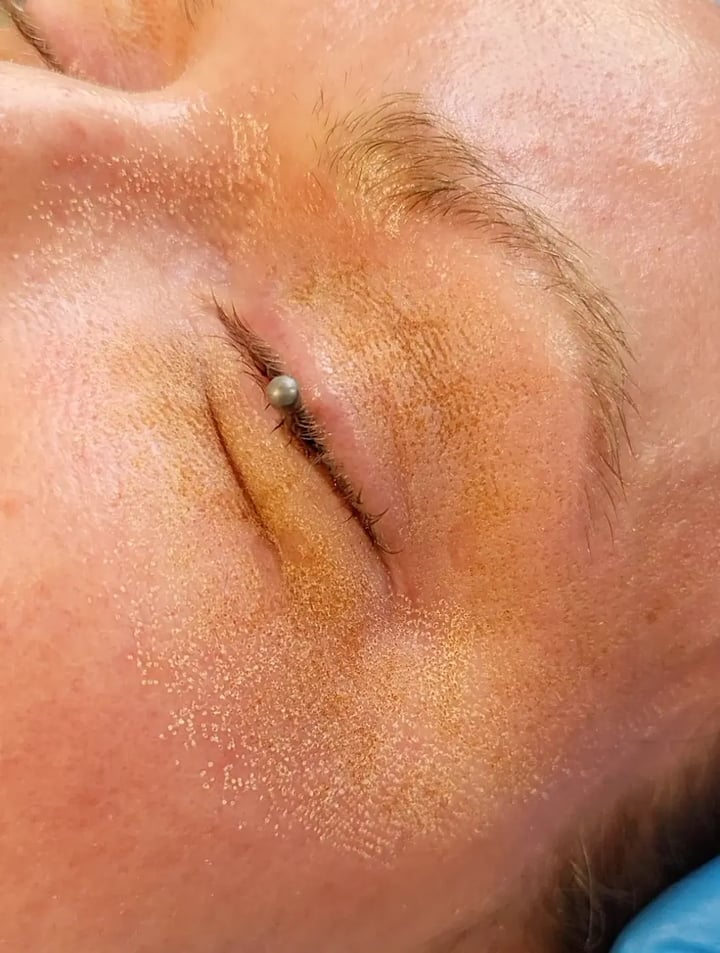 Fractional CO2 Laser Healing Process: An Aftercare Guide