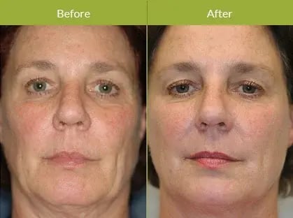 rf-skin-tightening-before-and-after-showing-a-woman’s-face-with-visible-skin-tightening-smoother-complexion-and-firmer-jawline-in-side-by-side-comparison