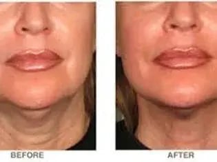 rf-skin-tightening-before-and-after-showing-lower-face-and-neck-with-visible-reduction-in-sagging-skin-and-improved-jawline-definition-in-side-by-side-comparison