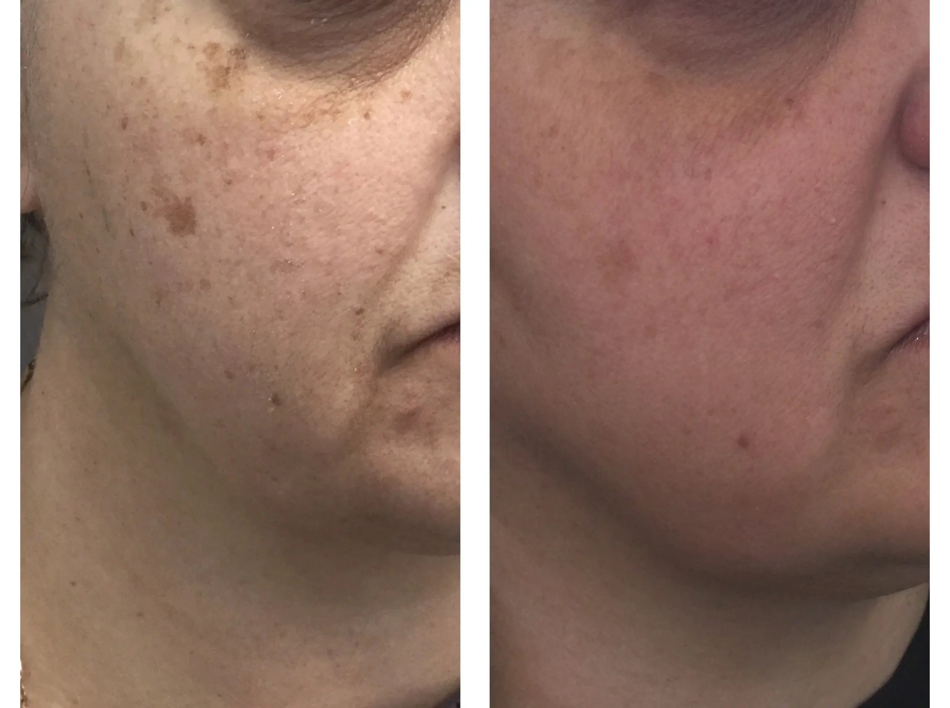 side-by-side-close-up-of-womans-cheek-showing-reduction-of-brown-spots-and-smoother-skin-texture-demonstrating-intense-pulsed-light-results-after-treatment
