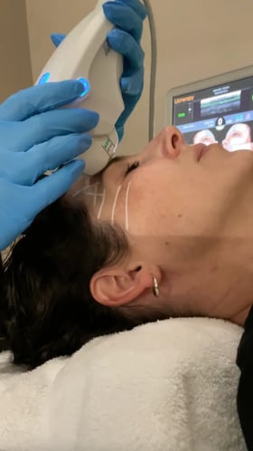 technician-wearing-blue-gloves-performing-ultherapy-saskatoon-treatment-on-patient-forehead-using-ultrasound-device-with-marked-guidelines-and-screen-visible-in-background