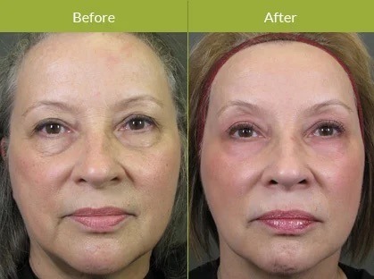 woman with CO2 Laser