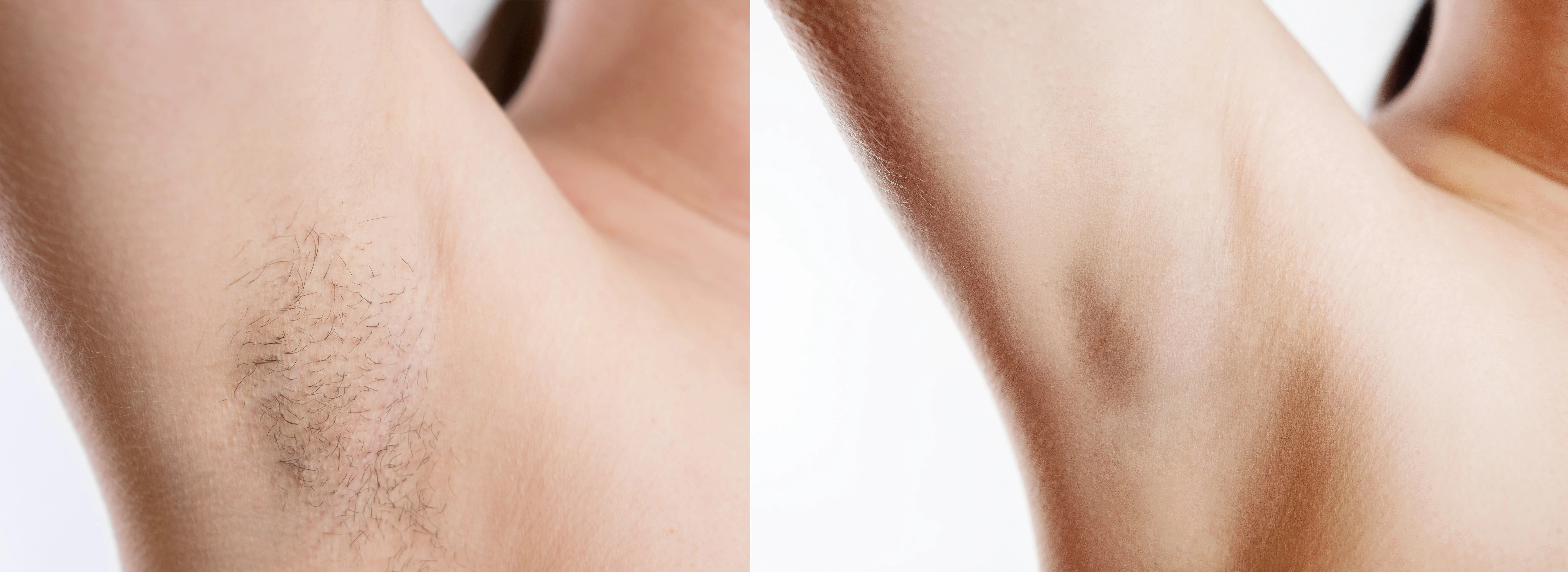 underarm-before-and-after-photo-showing-results-related-to-how-to-prepare-for-laser-hair-removal-with-visible-difference-between-hairy-and-smooth-skin