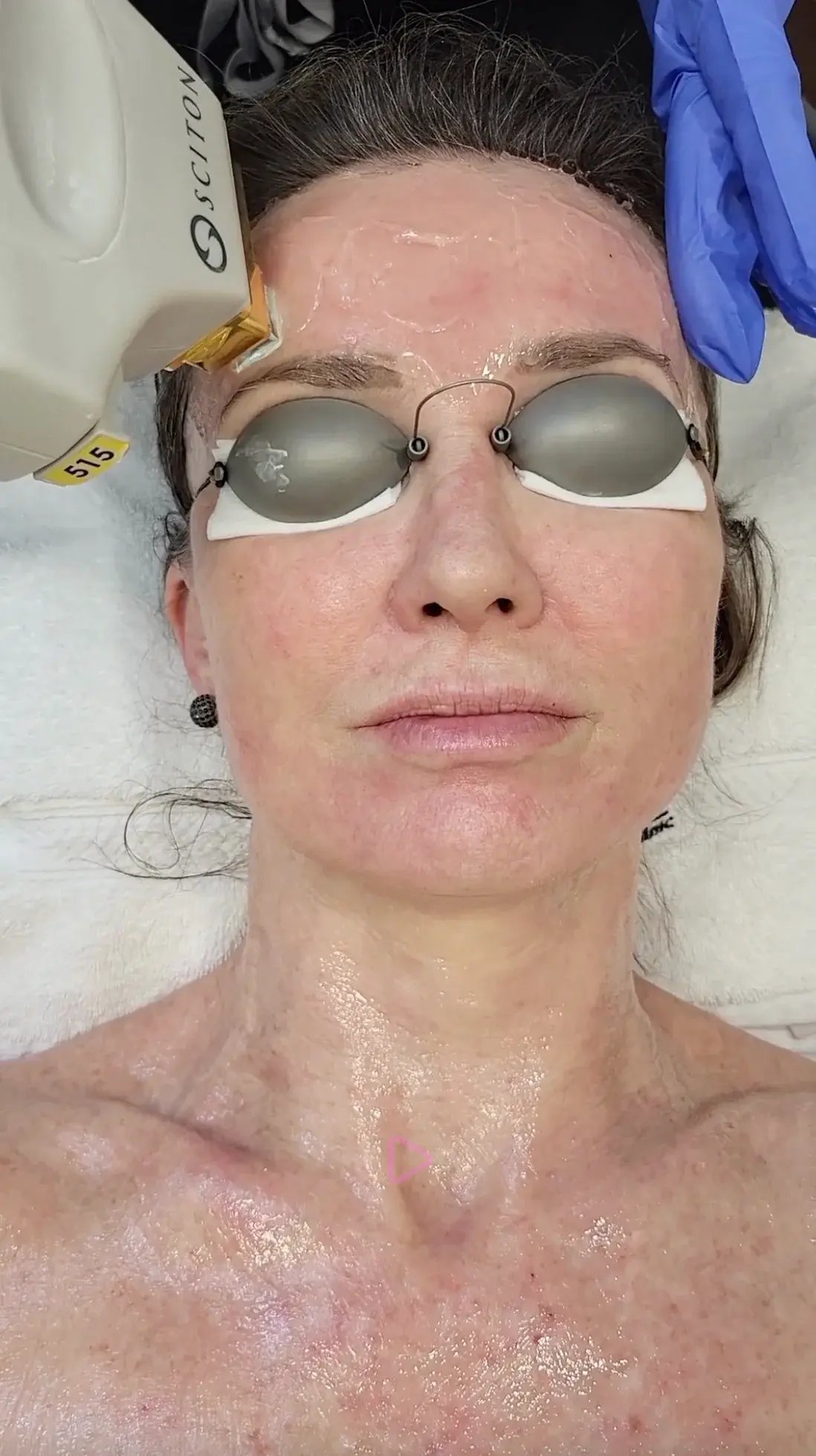 woman-lying-on-treatment-bed-wearing-protective-goggles-while-technician-applies-ipl-device-to-her-forehead-during-facial-procedure