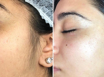 Dermaplaning Dermaplaning