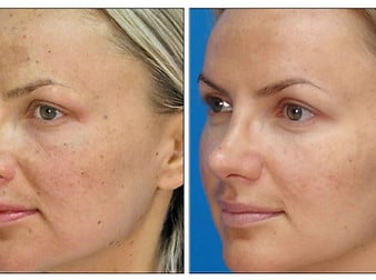 Fotona Micro Laser Peel Fotona Micro Laser Peel
