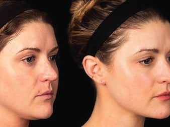 PRP - Platelet Rich Plasma PRP - Platelet Rich Plasma