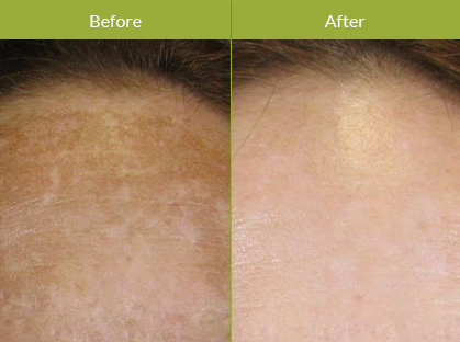 What is Zo Controlled Depth Blue Peel? What is Zo Controlled Depth Blue Peel?