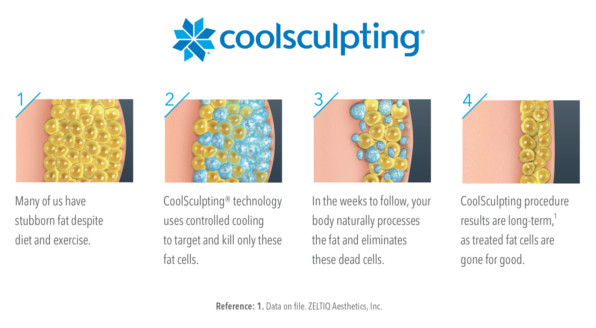 Coolsculpting
