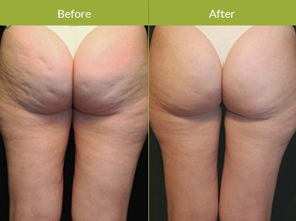 Before After Image