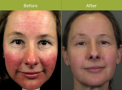 Rosacea Rosacea