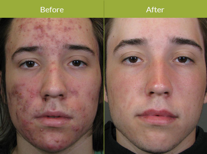 Acne Acne