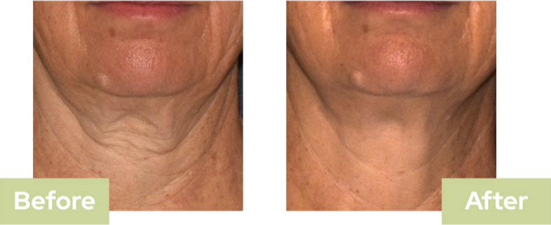 Sofwave Treatment Saskatoon Before & After - Bella Sante MD