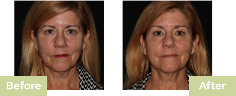 Sofwave Ultrasound Treatment Saskatoon Before & After - Bella Sante MD